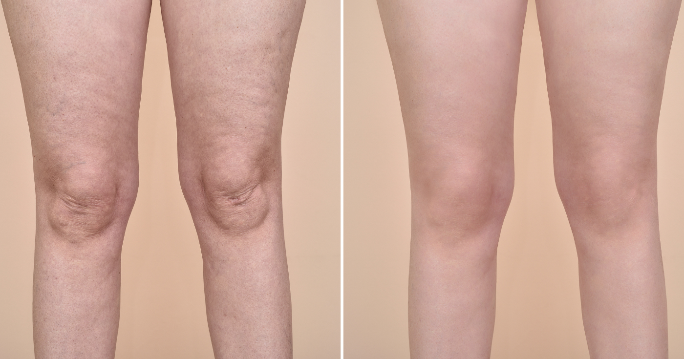 Bu spor "büyükanne" Çarpıcı sonuçlarla silüeti şekillendirir ve selüliti pürüzsüzleştirir