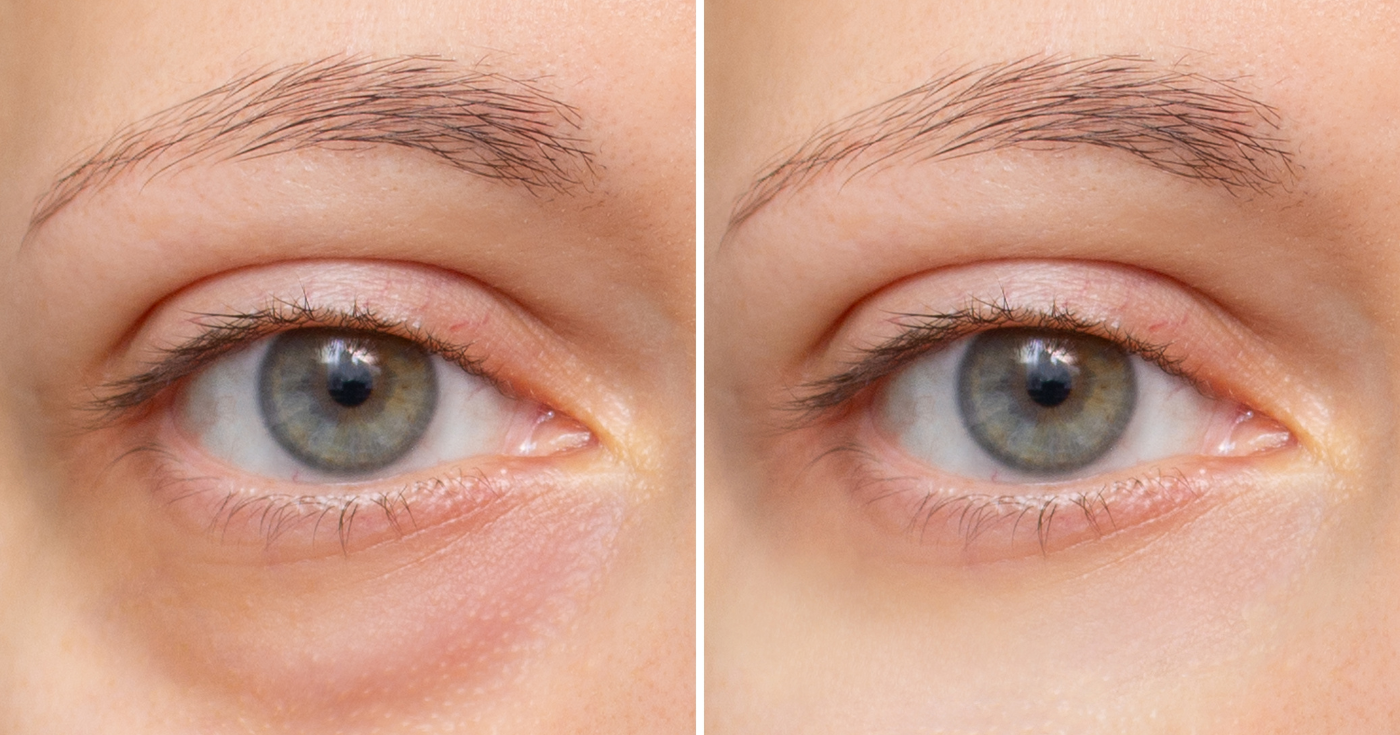 Hiçbir zaman kaybolmayan bu koyu halkalar: Dermatologlar tarafından nihayet onları gerçekten azaltmak için onaylanan bu protokol