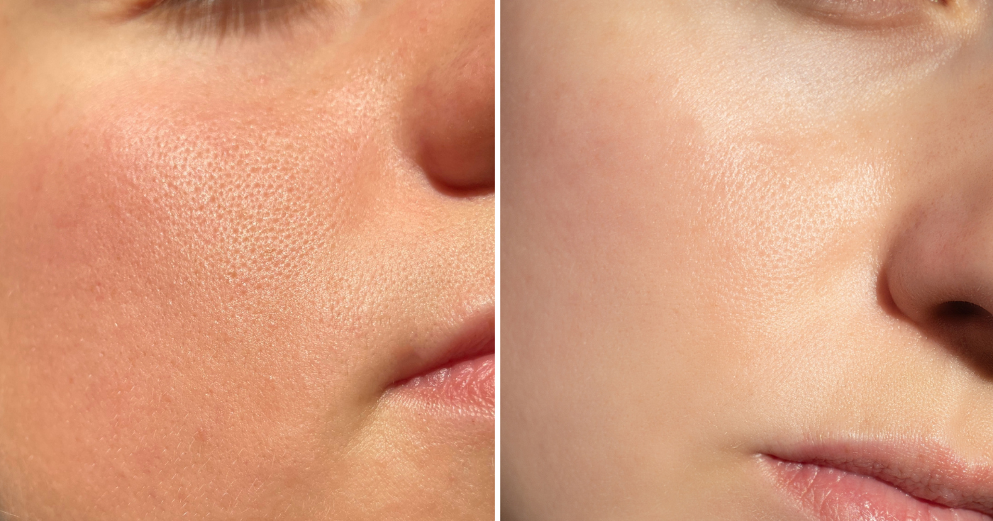 “Instagram filtresine benziyor”: Bu toz genişlemiş gözenekleri tek geçişte siliyor, tuvali paniğe sürüklüyor