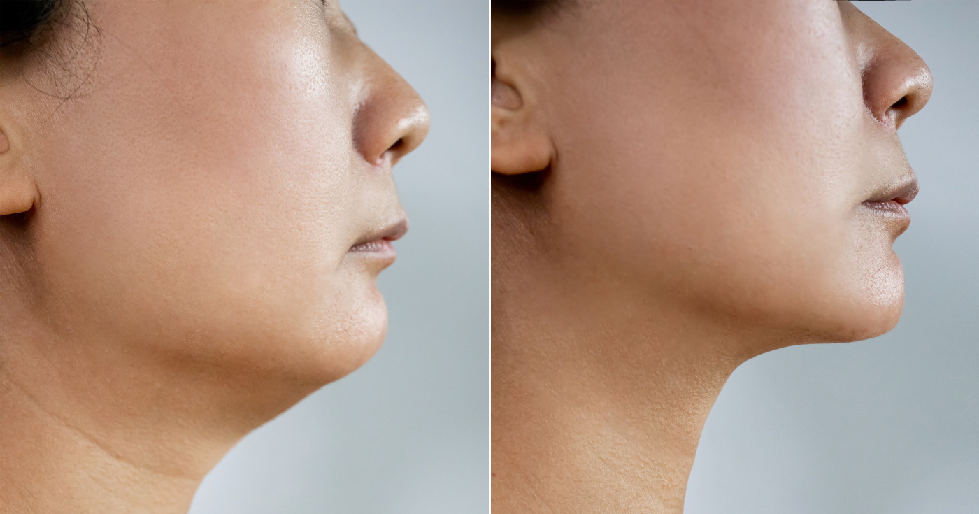 "Kavanozda yüz gerdirme" : Bu Charlotte Tilbury tedavisi cildi sadece 28 saniyede dolgunlaştırıyor