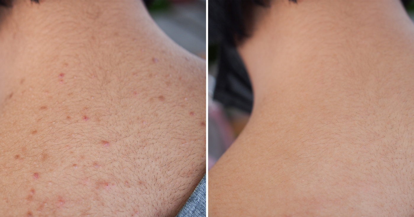 "Sırtımdaki sivilceler gitti" : Eczanelerde satılan bu organik temizleme jeli kusurları etkili bir şekilde hedef alır