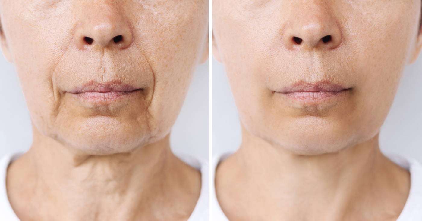 Fermente hyaluronik asit: daha dolgun bir cilt vaat eden yeni nesil kırışıklık karşıtı içerik