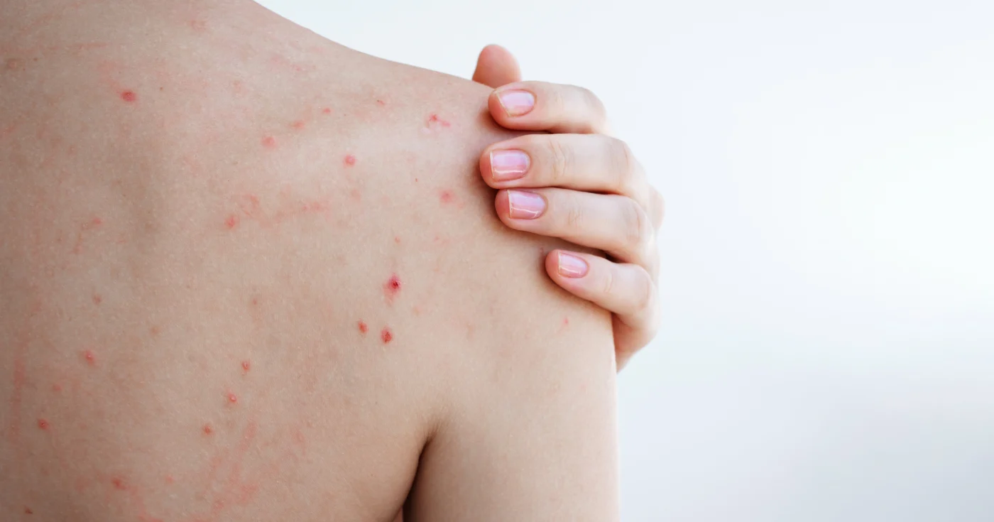 Vücut sivilceleri: dermatolojik olarak test edilmiş bu 360° sprey sırt, göğüs ve omuzlardaki kusurları azaltır