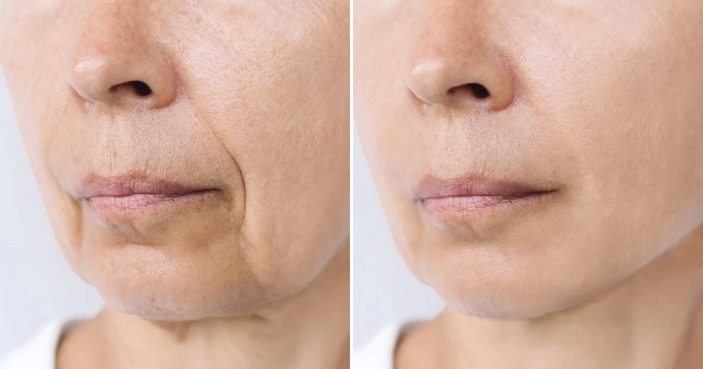 Ridules autour de la bouche : ce soin à l’acide hyaluronique noté 100/100 sur Yuka promet un effet repulpant sans injection