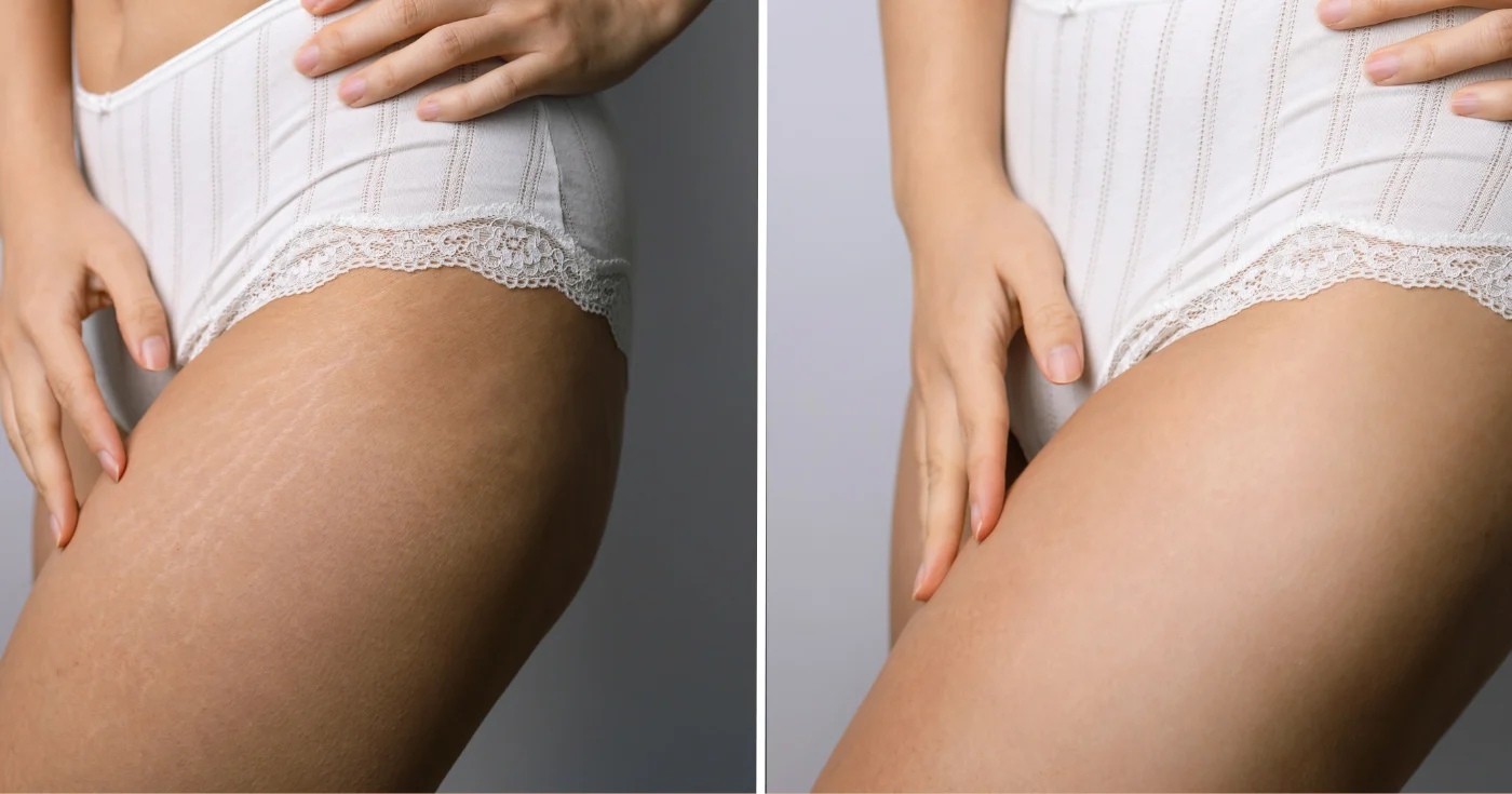 « Ce produit a atténué tous mes problèmes de peau » : cette mousse-en-huile anti-âge agit comme un sérum pour corriger à la fois les taches, les vergetures et les rides