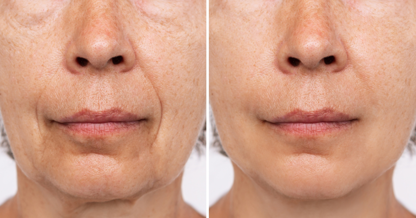 “Gülümseme çizgileri”: Birden fazla aktif bileşen içeren bu 360° serum, derin kırışıklıkları sonunda silmek için cilt yaşlanmasının 8 gözle görülür belirtisini hedef alır