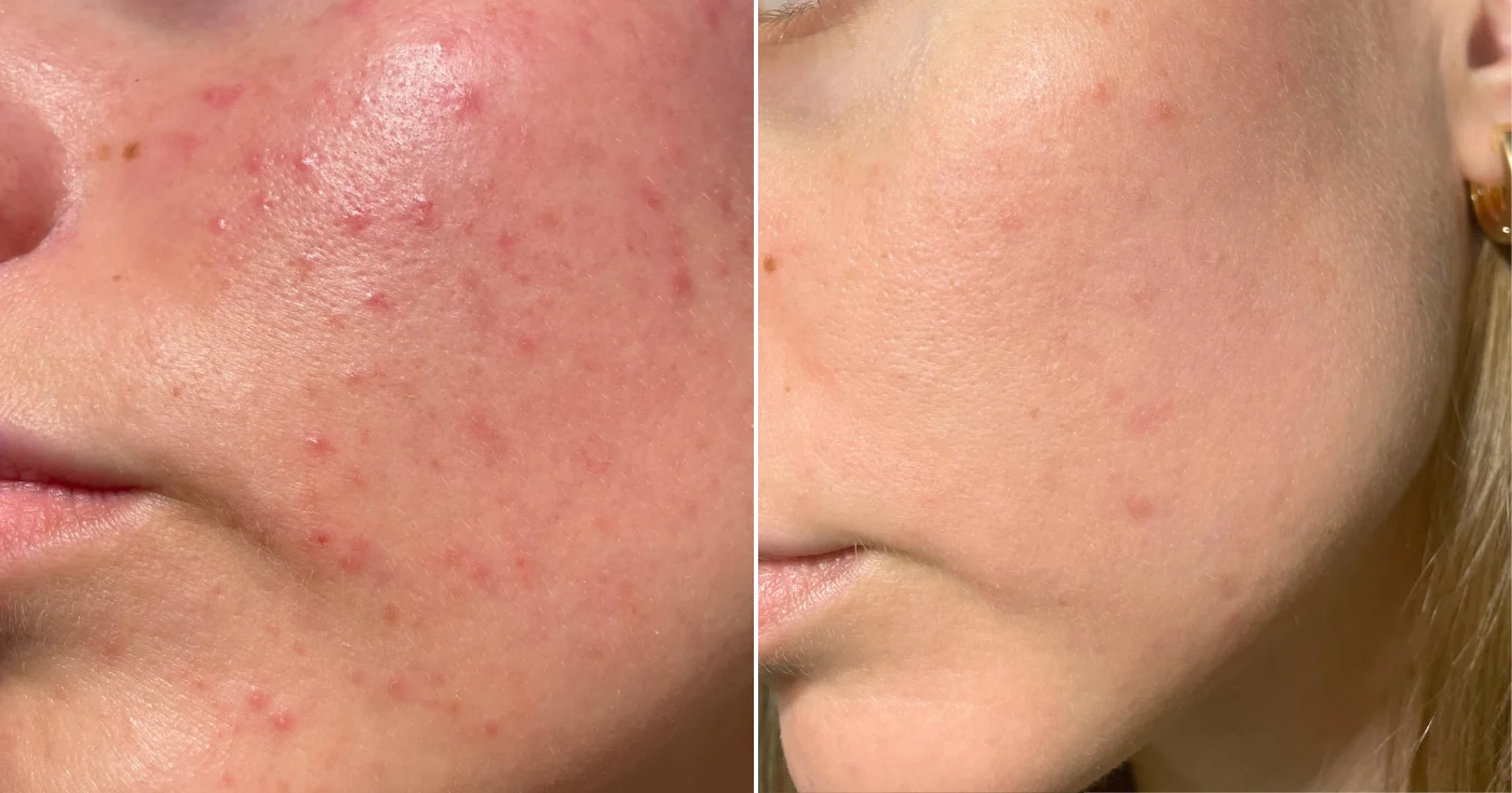 Kızarıklık ve sivilceler: "hepimizin yaptığı bu güzellik alışkanlığı cilt bariyerini yok ediyor" bu dermatoloğu uyar